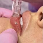 Dermapen Labios 35mins